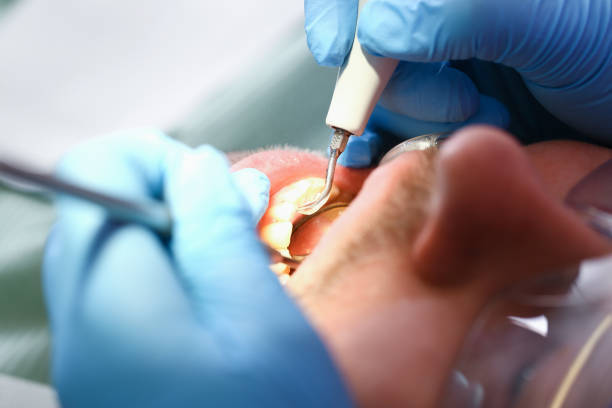Best Emergency Wisdom Teeth Removal in National Park, NJ